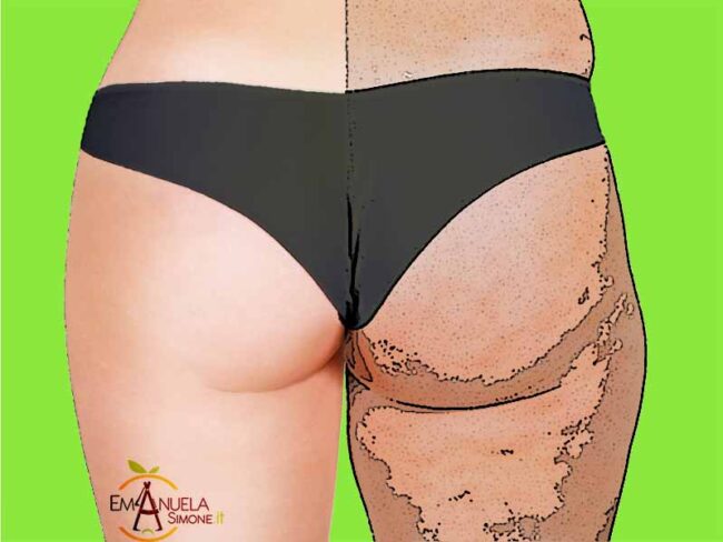 cellulite_emanuela_simone_benevento cellulite