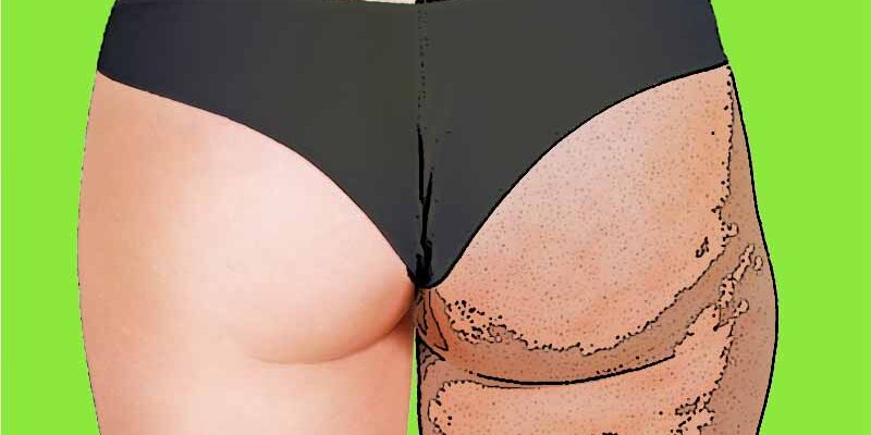 cellulite_emanuela_simone_benevento cellulite