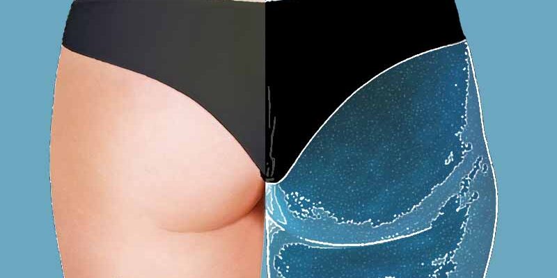 cellulite_rgx_emanuela_simone cellulite