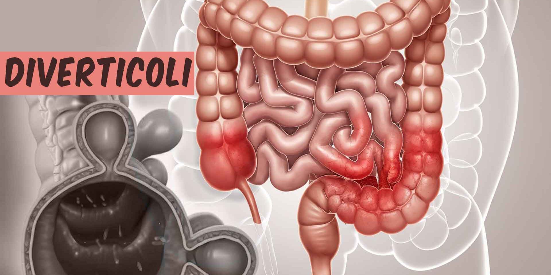 Diverticolite e colon infiammato
