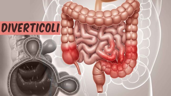 diverticolite4 Diverticolite e colon infiammato