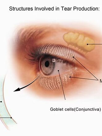 DED sindrome occhio secco Sindrome occhio secco
